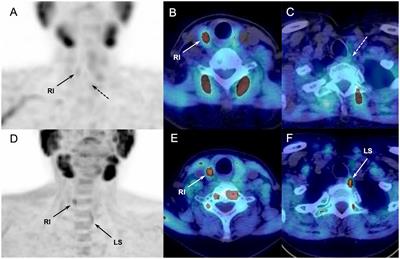 Does 18F-Fluorocholine PET/CT add value to positive parathyroid scintigraphy in the presurgical assessment of primary hyperparathyroidism?